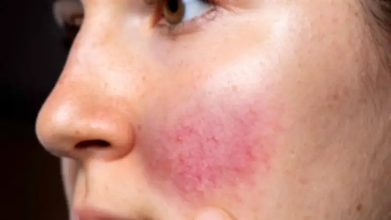 دليل شامل للتعامل مع حروق الوجه: تجنب الأخطاء الشائعة لحماية بشرتك