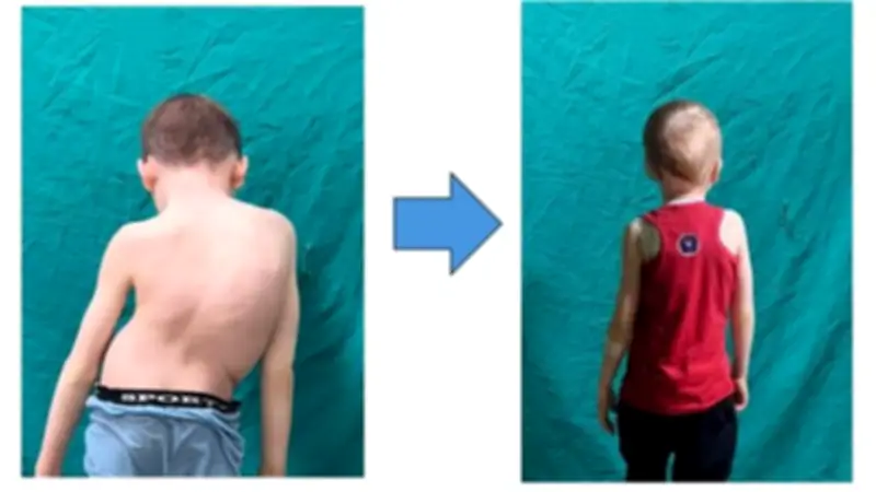 نجاح فريق طبي بجامعة أسيوط في علاج طفل من تشوه حاد بالعمود الفقري بتقنية حديثة