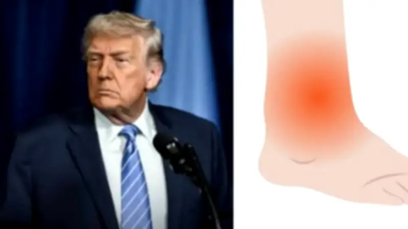 تورم كاحل ترامب وصعوبة مشيته.. أبرز الأسباب الطبية وتأثيرها على صحته العامة
