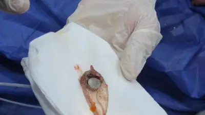 استخراج بطارية من معدة طفلة 4 سنوات بمنظار بمستشفى أبو كبير