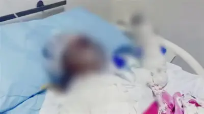 طفلة الشرقية تودع الحياة بعد حروق مميتة.. والنيابة تفتح تحقيقًا موسعًا