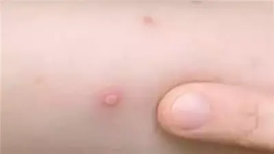 أخصائي أطفال يحذر: عدوى الجدري المائي تنتشر قبل ظهور الأعراض بيومين