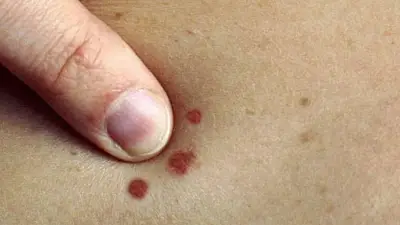 علامات خطيرة على الجلد تكشف الإصابة بسرطان الجلد.. لا تتجاهلها قبل فوات الأوان