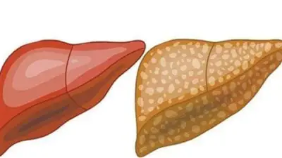 نظام غذائي أسبوعي متكامل لعلاج الكبد الدهني وتحسين الصحة العامة