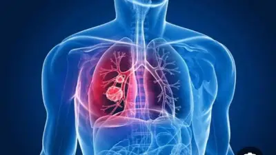 نصائح حاسمة بعد التعافي من الالتهاب الرئوي: خطوات وقائية لتجنب الانتكاسة