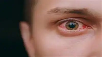 الرمد الربيعي يهدد العيون في موسم الخماسين.. إرشادات طبية عاجلة للوقاية من الأتربة