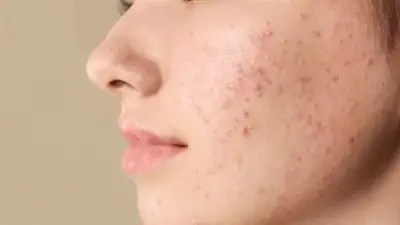 أخصائية تغذية تحذر: هذه الأكلات قد تسبب ظهور حب الشباب وتفاقمه