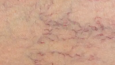 الأسباب الشائعة لظهور خطوط الشعيرات الدموية في الوجه والأرجل