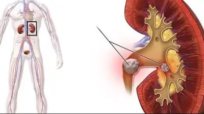 أسباب تكون حصوات الكلى وطرق تجنبها والإصابة بالفشل الكلوي