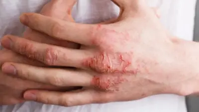 كيف تفرق بين الصدفية والإكزيما؟ الفروق الأساسية التي يجب معرفتها