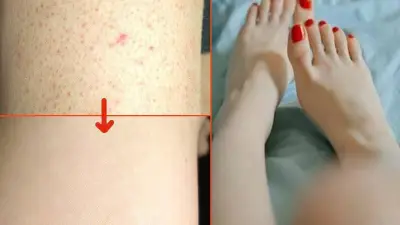 جلد الوزة: طرق فعالة للتخلص من المظهر الخشن في وقت قياسي