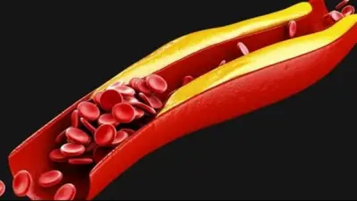 علامات في أصابع اليدين والقدمين تؤكد ارتفاع الكوليسترول بالدم