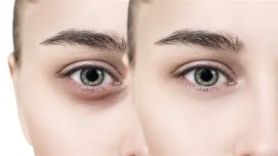 كمادات باردة طبيعية لعلاج الهالات السوداء الناتجة عن السهر