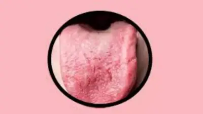 سوء التغذية يسبب تشققات اللسان المرتبطة بنقص الفيتامينات