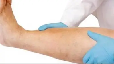 استشاري أمراض قلب يكشف أسباب وأعراض جلطة الساق وطرق علاجها