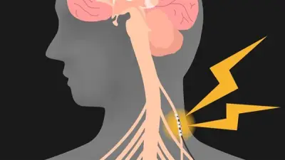 العصب الحائر: الأعراض والأسباب وطرق العلاج الحديثة