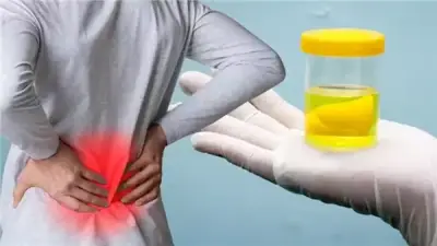 علاج زلال البول وأسباب الإصابة به.. إهماله يسبب مضاعفات خطيرة