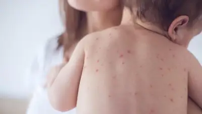 نشرة المرأة والمنوعات: أسباب تقصف الأظافر والجدري المائي يهاجم الأطفال