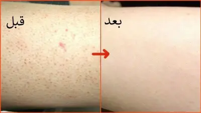 علاج جلد الوزة بالوصفات الطبيعية: حلول فعالة في زمن قياسي