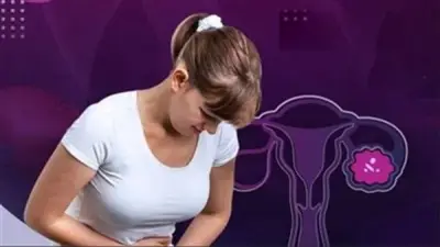 علامات تكيسات المبايض: أعراض شائعة يجب أن تنتبهي إليها لتشخيص مبكر