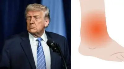تورم كاحل ترامب وصعوبة مشيته.. أبرز الأسباب الطبية وتأثيرها على صحته العامة