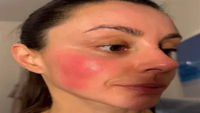 تحذير من مرض جلدي يصيب النساء في الثلاثينيات.. أعراضه تظهر على البشرة