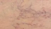 الأسباب الشائعة لظهور خطوط الشعيرات الدموية في الوجه والأرجل