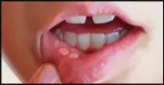 وداعًا لقرح الفم.. حلول بسيطة من مطبخك تقضي على الألم