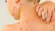 الجدري المائي يهاجم الأطفال: أعراض لا يجب تجاهلها وطرق الوقاية