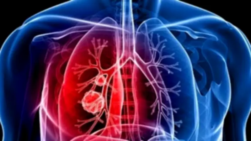 أكياس النيكوتين تسبب مرض رئة الفشار.. 5 أعراض تحذيرية