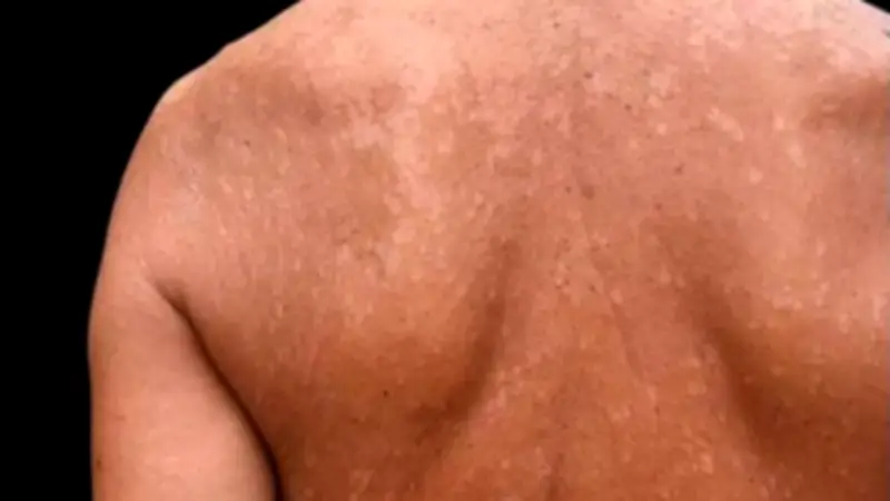 أسباب وأعراض التينيا وطرق علاجها: دليل شامل للوقاية