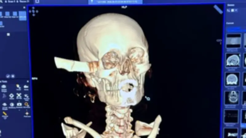قصر العيني ينجح في استخراج سكين من جمجمة مريضة في عملية نادرة