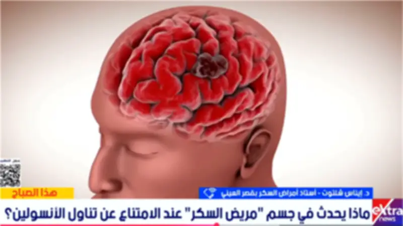 خطر التوقف عن الأنسولين: طبيبة تحذر من مضاعفات قاتلة لمرضى السكري