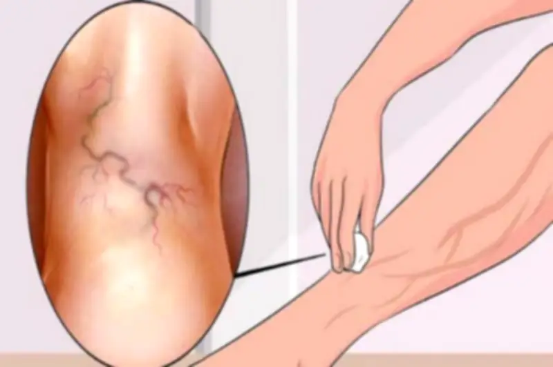 أربعة أعشاب طبيعية لعلاج دوالي القدمين والساقين