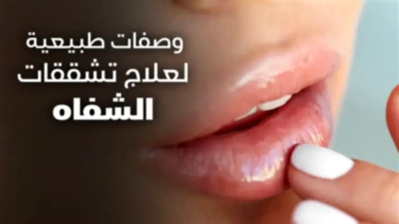 وصفات سريعة لترطيب الشفاه الجافة في الحر والصيام