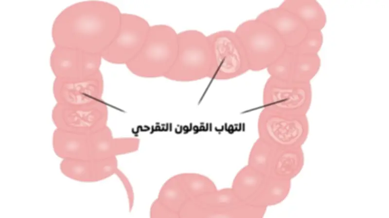القولون التقرحي: أنواعه وأسبابه وأعراضه المختلفة