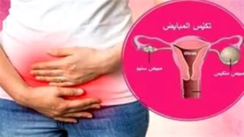 وزارة الصحة: تكيس المبايض يقلل فرص الحمل ويحتاج تشخيصا مبكرا