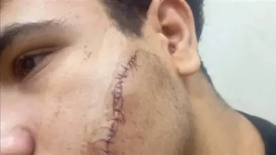 إصابة طالب بـ12 غرزة بعد مشاجرة عقب امتحان في شبرا الخيمة