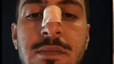 تعدي 15 شخصًا على شاب وكسر أنفه في زفة عروسين بوصلة دهشور