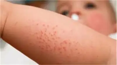 5 حيل منزلية ذكية للتخلص من حمو النيل في الصيف.. متى تزور الطبيب؟