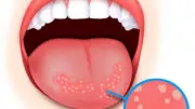 أسباب وأعراض فطريات الفم وعلاجها بمواد طبيعية فعالة