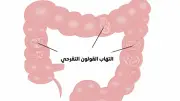 القولون التقرحي: أنواعه وأسبابه وأعراضه المختلفة