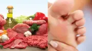نصائح غذائية لمرضى النقرس في عيد الأضحى لتجنب نوبات الألم