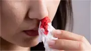 متى يكون نزيف الأنف رسالة تحذيرية من الجسم؟