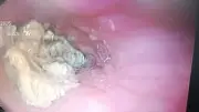 إنقاذ مريض من انسداد حاد بالمريء بعد انحشار الطعام في حلقه بمستشفى بنها