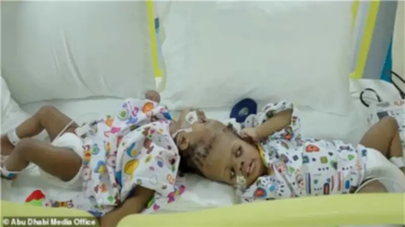 فصل توأمين ملتصقتين من الرأس بمساعدة الذكاء الاصطناعي في جراحة نادرة