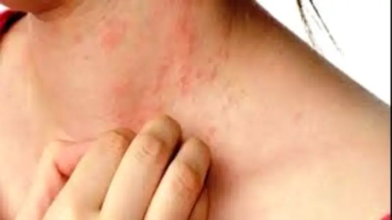 حساسية الصيف.. كل ما تريد معرفته عن حمو النيل وأسبابه وعلاجه