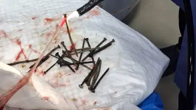 استخراج 100 مسمار وصامولة من معدة مريض بمنظار بمستشفى بني سويف الجامعي