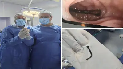 استخراج مسمار 5 سم من أمعاء طفل بالشرقية في عملية طارئة