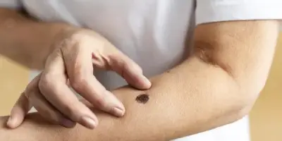 تطبيق ذكاء اصطناعي يحول الهاتف إلى أداة للكشف عن سرطان الجلد